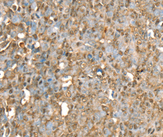 Immunohistochemistry of paraffin-embedded Human ovarian cancer using RBM5 Polyclonal Antibody at dilution of 1:30