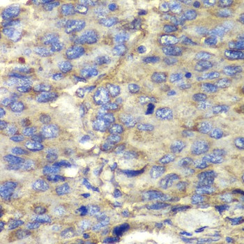 Immunohistochemistry of paraffin-embedded Human liver cancer using SDHA Polyclonal Antibody at dilution of  1:100 (40x lens).