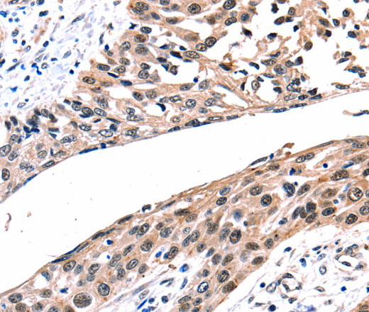 Immunohistochemistry of paraffin-embedded Human esophagus cancer tissue using Connexin-26 Polyclonal Antibody at dilution 1:100