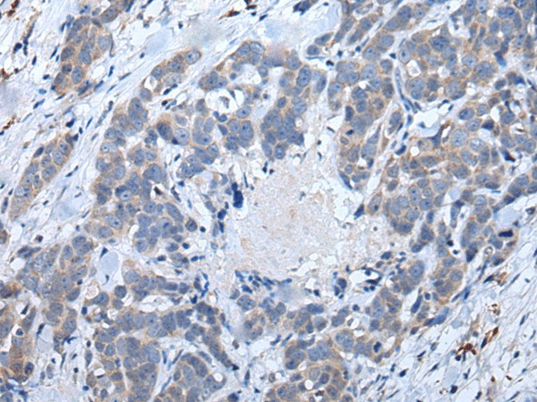 Immunohistochemistry of paraffin-embedded Human thyroid cancer tissue  using ATM Polyclonal Antibody at dilution of 1:65(?200)