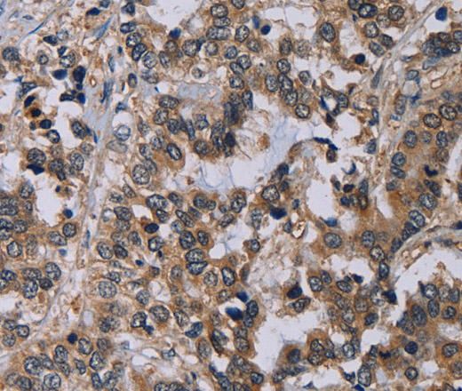 Immunohistochemistry of paraffin-embedded Human liver cancer using NECTIN4 Polyclonal Antibody at dilution of 1:60