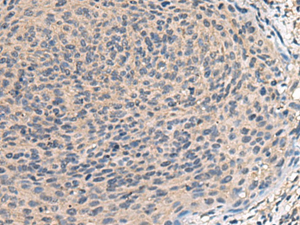 Immunohistochemistry of paraffin-embedded Human cervical cancer tissue  using TNF Polyclonal Antibody at dilution of 1:40(?200)