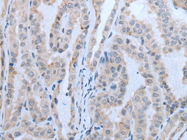 Immunohistochemistry of paraffin-embedded Human thyroid cancer tissue  using IGF2BP3 Polyclonal Antibody at dilution of 1:30(?200)