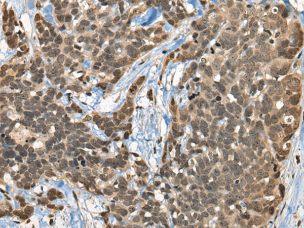 Immunohistochemistry of paraffin-embedded Human thyroid cancer tissue  using CBFA2T3 Polyclonal Antibody at dilution of 1:45(?200)