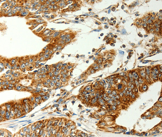 Immunohistochemistry of paraffin-embedded Human gastic cancer using COX7B Polyclonal Antibody at dilution of 1:70