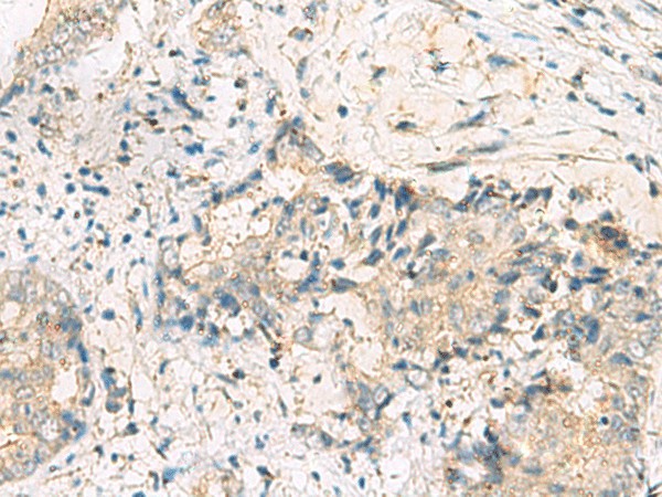 Immunohistochemistry of paraffin-embedded Human cervical cancer tissue  using MGAT4B Polyclonal Antibody at dilution of 1:50(?200)