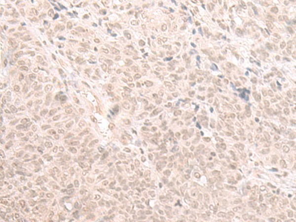 Immunohistochemistry of paraffin-embedded Human ovarian cancer tissue  using HOOK2 Polyclonal Antibody at dilution of 1:30(?200)