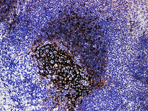 Immunohistochemistry of paraffinembedded Human tonsil tissue with CD23 Monoclonal Antibody(Antigen repaired by EDTA).