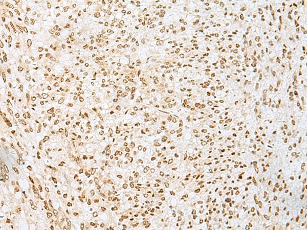 Immunohistochemistry of paraffin-embedded Human liver cancer tissue  using PNRC2 Polyclonal Antibody at dilution of 1:30(?200)