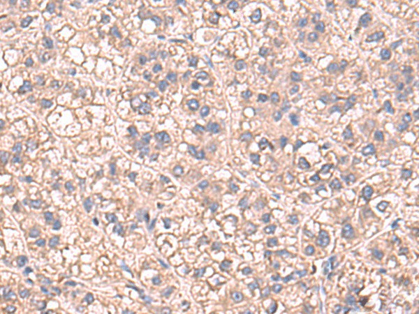 Immunohistochemistry of paraffin-embedded Human liver cancer tissue  using SARS Polyclonal Antibody at dilution of 1:60(?200)