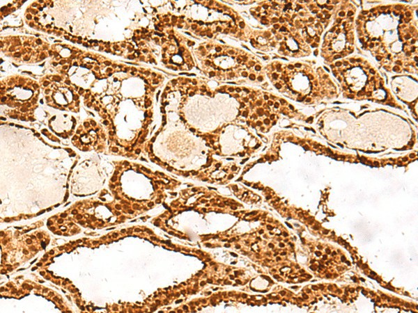 Immunohistochemistry of paraffin-embedded Human thyroid cancer tissue  using ADRM1 Polyclonal Antibody at dilution of 1:30(?200)