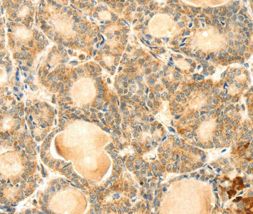 Immunohistochemistry of paraffin-embedded Human thyroid cancer using EVA1A Polyclonal Antibody at dilution of 1:30