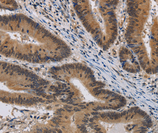 Immunohistochemistry of paraffin-embedded Human colon cancer using KCNG4 Polyclonal Antibody at dilution of 1:40