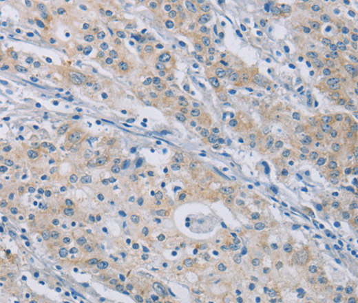 Immunohistochemistry of paraffin-embedded Human gastric cancer tissue using CERKL Polyclonal Antibody at dilution 1:50