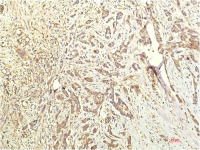 Immunohistochemistry of paraffin-embedded Human breast carcinoma tissue using STAT1 Monoclonal Antibody at dilution of 1:200.