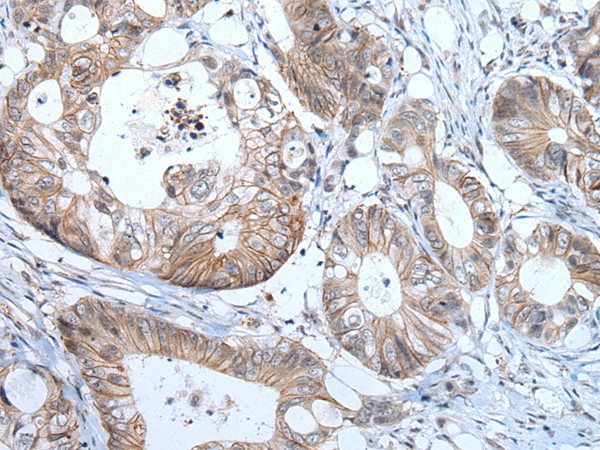 Immunohistochemistry of paraffin-embedded Human colorectal cancer tissue  using PRSS50 Polyclonal Antibody at dilution of 1:65(?200)