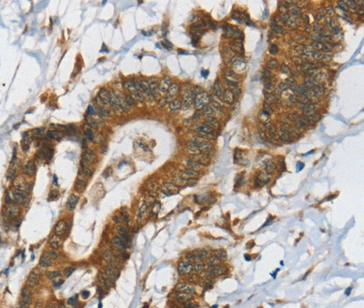 Immunohistochemistry of paraffin-embedded Human colon cancer tissue using RPS6KA2 Polyclonal Antibody at dilution 1:40