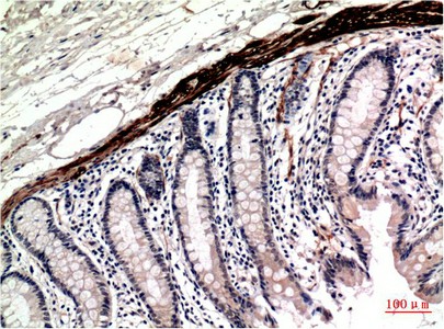 Immunohistochemistry of paraffin-embedded Human colon carcinoma tissue using ACTA1 Monoclonal Antibody at dilution of 1:200.