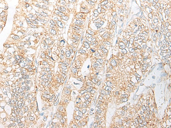 Immunohistochemistry of paraffin-embedded Human gastric cancer tissue  using NME4 Polyclonal Antibody at dilution of 1:45(?200)