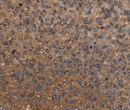 Immunohistochemistry of paraffin-embedded Human renal cancer tissue using HYAL2 Polyclonal Antibody at dilution 1:60