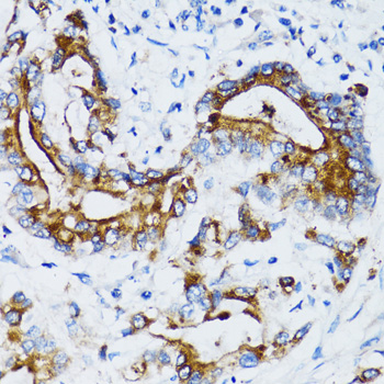 Immunohistochemistry of paraffin-embedded Human colon carcinoma using MMP7 Polyclonal Antibody at dilution of 1:100 (40x lens).
