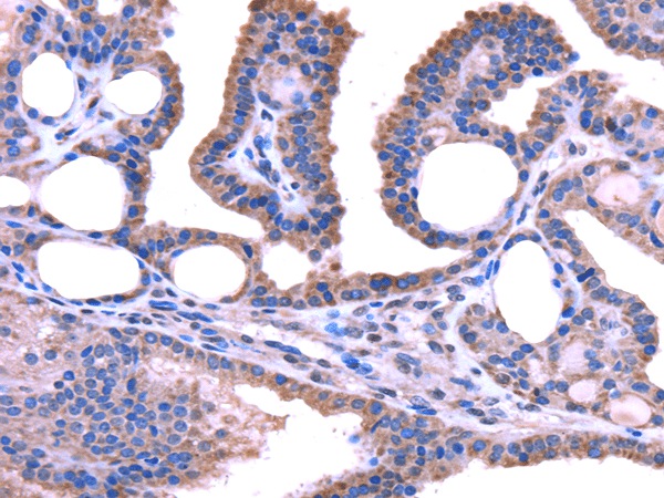 Immunohistochemistry of paraffin-embedded Human thyroid cancer tissue using TRIM49 Polyclonal Antibody at dilution 1:40