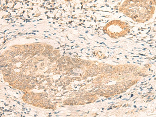 Immunohistochemistry of paraffin-embedded Human esophagus cancer tissue  using CALCOCO1 Polyclonal Antibody at dilution of 1:40(?200)