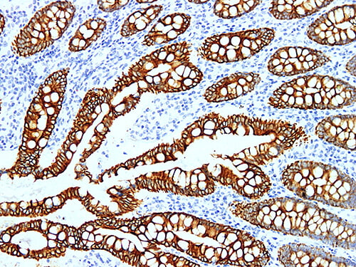 Immunohistochemistry of paraffinembedded Human colon cancer tissue with Cytokeratin 19 Monoclonal Antibody(Antigen repaired by EDTA).