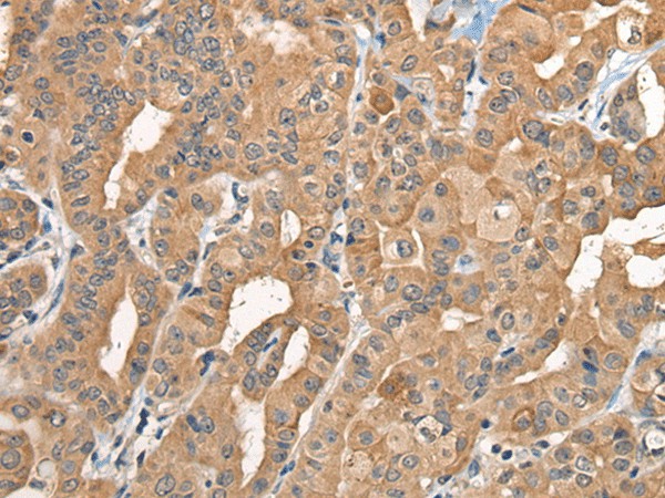 Immunohistochemistry of paraffin-embedded Human thyroid cancer tissue  using BCAN Polyclonal Antibody at dilution of 1:35(?200)