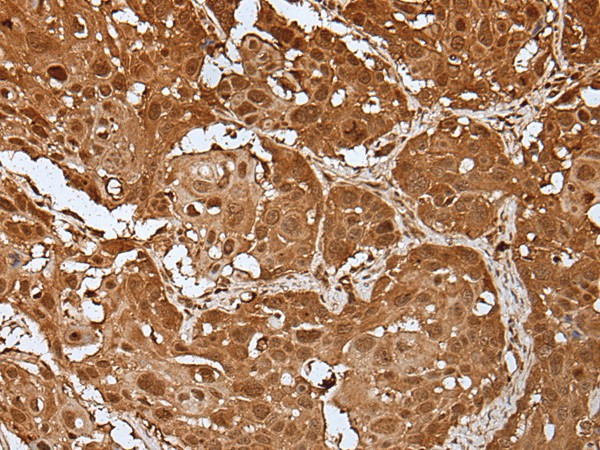 Immunohistochemistry of paraffin-embedded Human esophagus cancer tissue  using UBA7 Polyclonal Antibody at dilution of 1:35(?200)