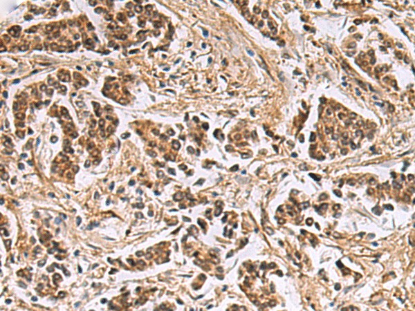 Immunohistochemistry of paraffin-embedded Human breast cancer tissue  using DNA2 Polyclonal Antibody at dilution of 1:40(?200)