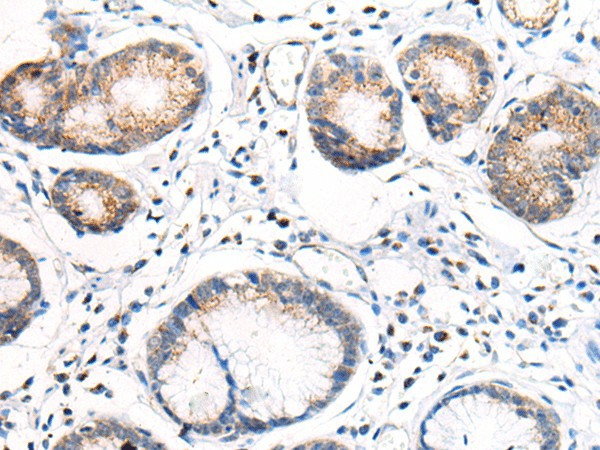 Immunohistochemistry of paraffin-embedded Human gastric cancer tissue  using ANAPC15 Polyclonal Antibody at dilution of 1:70(?200)