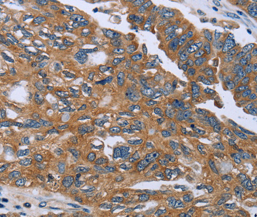 Immunohistochemistry of paraffin-embedded Human ovarian cancer using GAB2 Polyclonal Antibody at dilution of 1:40