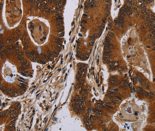 Immunohistochemistry of paraffin-embedded Human colon cancer tissue using DCAF6 Polyclonal Antibody at dilution 1:50