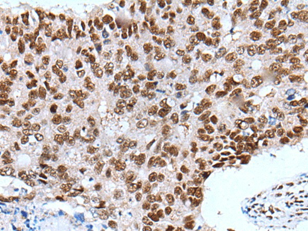 Immunohistochemistry of paraffin-embedded Human colorectal cancer tissue  using XAB2 Polyclonal Antibody at dilution of 1:25(?200)