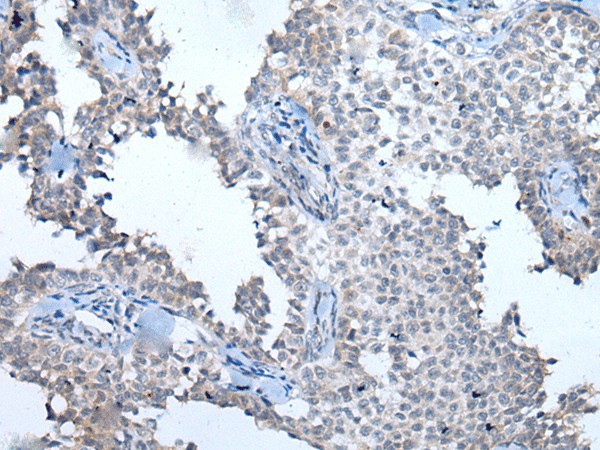 Immunohistochemistry of paraffin-embedded Human ovarian cancer tissue  using ATM Polyclonal Antibody at dilution of 1:65(?200)