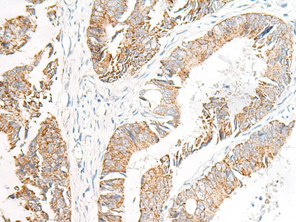 Immunohistochemistry of paraffin-embedded Human colorectal cancer tissue  using FGR Polyclonal Antibody at dilution of 1:70(?200)