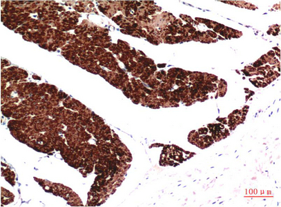 Immunohistochemistry of paraffin-embedded Human colon carcinoma tissue using ACTA1 Monoclonal Antibody at dilution of 1:200.