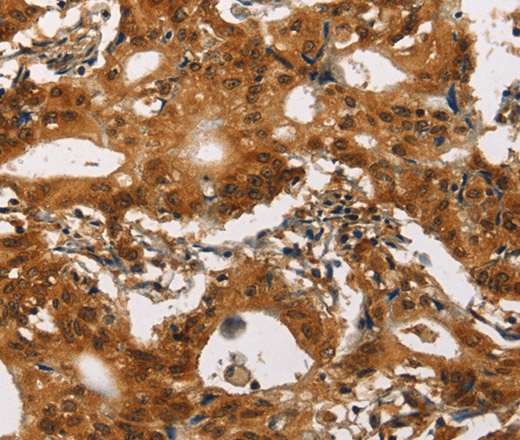 Immunohistochemistry of paraffin-embedded Human gasrtic cancer tissue using Cav1.2 Polyclonal Antibody at dilution 1:30