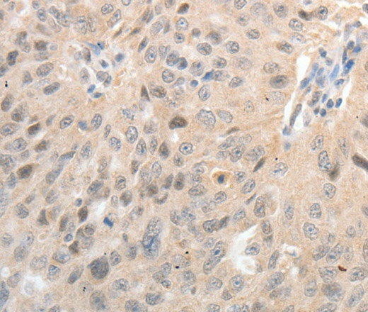 Immunohistochemistry of paraffin-embedded Human ovarian cancer tissue using ASCL1 Polyclonal Antibody at dilution 1:30