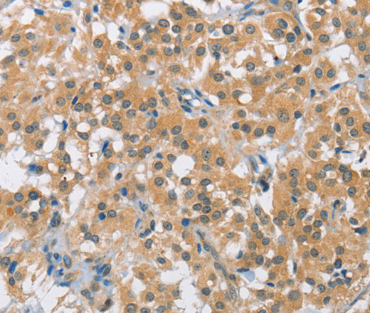 Immunohistochemistry of paraffin-embedded Human thyroid cancer using BCL10 Polyclonal Antibody at dilution of 1:40