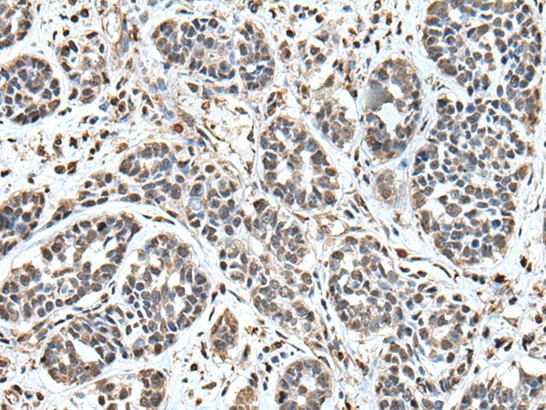 Immunohistochemistry of paraffin-embedded Human esophagus cancer tissue  using UPK3A Polyclonal Antibody at dilution of 1:55(?200)