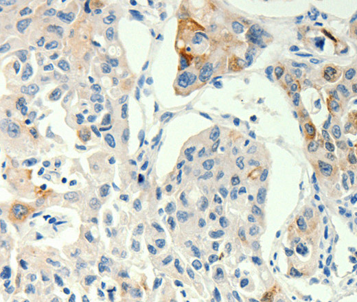 Immunohistochemistry of paraffin-embedded Human lung cancer tissue using TRPA1 Polyclonal Antibody at dilution 1:60