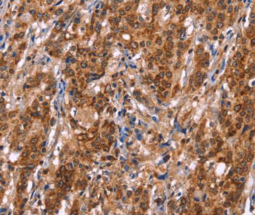 Immunohistochemistry of paraffin-embedded Human gasrtic cancer tissue using TDP2 Polyclonal Antibody at dilution 1:40