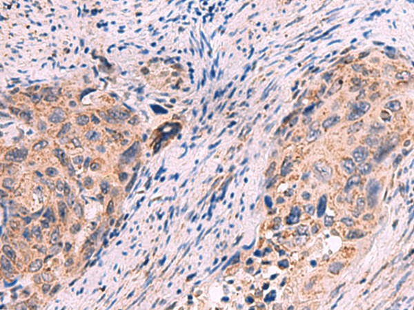 Immunohistochemistry of paraffin-embedded Human cervical cancer tissue  using KCNN1 Polyclonal Antibody at dilution of 1:55(?200)