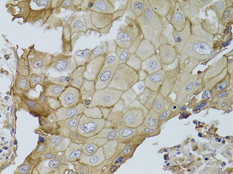 Immunohistochemistry of paraffin-embedded Human breast cancer using GGT1 Polyclonal Antibody at dilution of  1:100 (40x lens).