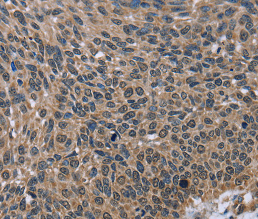 Immunohistochemistry of paraffin-embedded Human lung cancer using IMPDH2 Polyclonal Antibody at dilution of 1:60