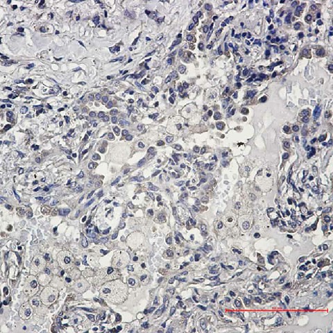 Immunohistochemistry of AKT1/2/3 in paraffin-embedded Human lung cancer tissue using AKT1/2/3 Rabbit mAb at dilution 1:50