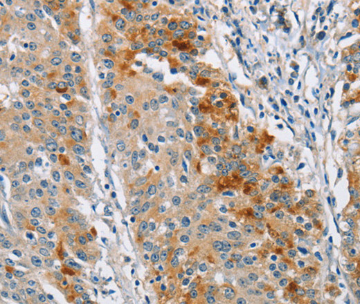 Immunohistochemistry of paraffin-embedded Human gastric cancer using BCL10 Polyclonal Antibody at dilution of 1:40