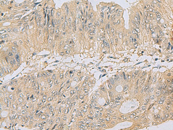 Immunohistochemistry of paraffin-embedded Human colorectal cancer tissue  using TSTA3 Polyclonal Antibody at dilution of 1:80(?200)